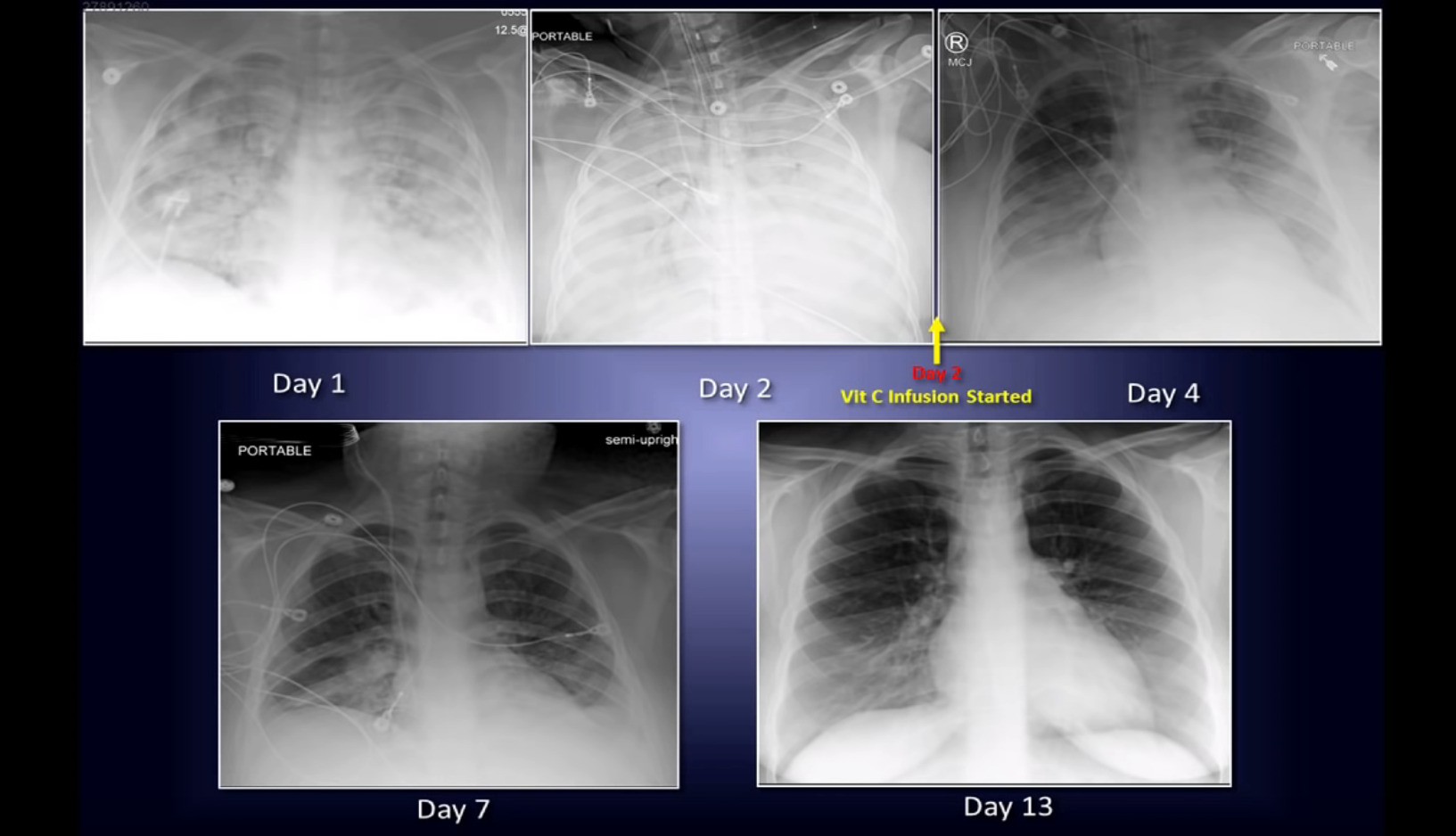 Intravenous Vitamin C: Pathway to a New Therapy to Save Lives